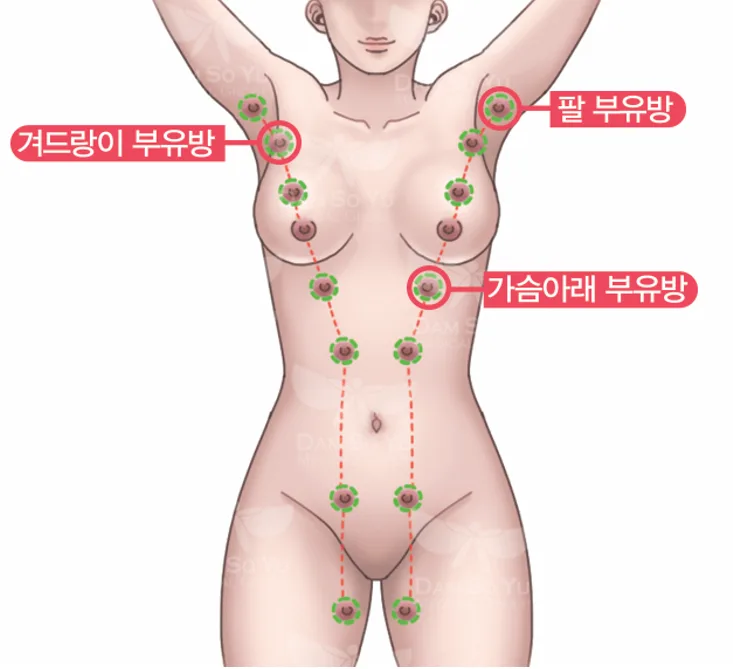 标示腋下、手臂和乳房下方副乳位置的示意图