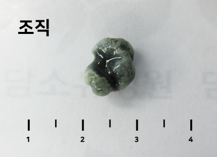담석