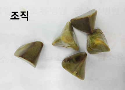 담석