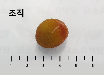 담석